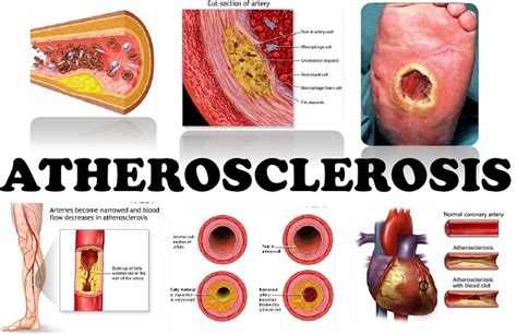 what is the impact of arteriosclerosis topic test|can arteriosclerosis affect blood flow.